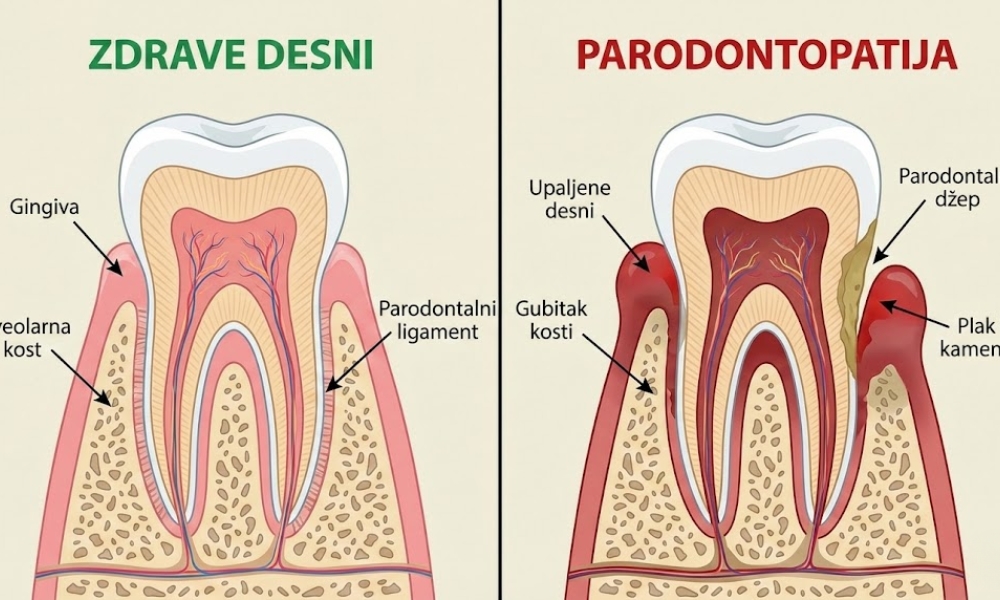 Šta je parodontopatija