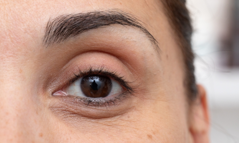 Kako ukloniti podočnjake